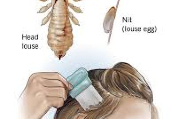 HOW TO TREAT HAIR LICE AT HOME YOURSELF